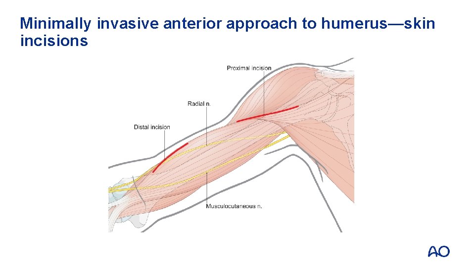 Minimally invasive anterior approach to humerus—skin incisions 