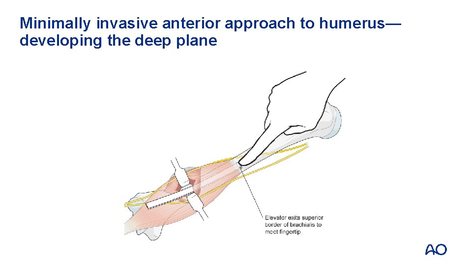 Minimally invasive anterior approach to humerus— developing the deep plane 