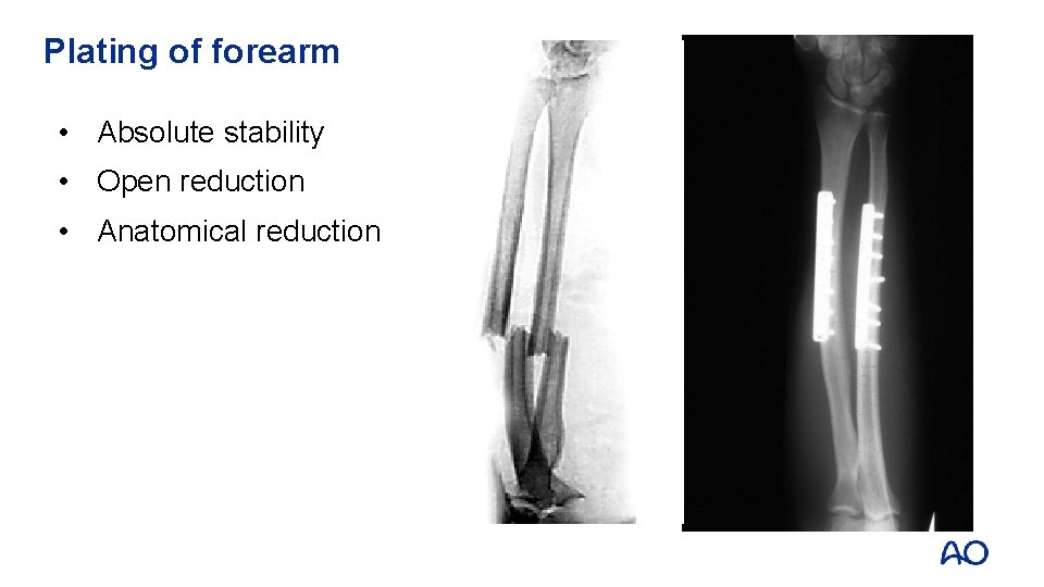 Plating of forearm • Absolute stability • Open reduction • Anatomical reduction 