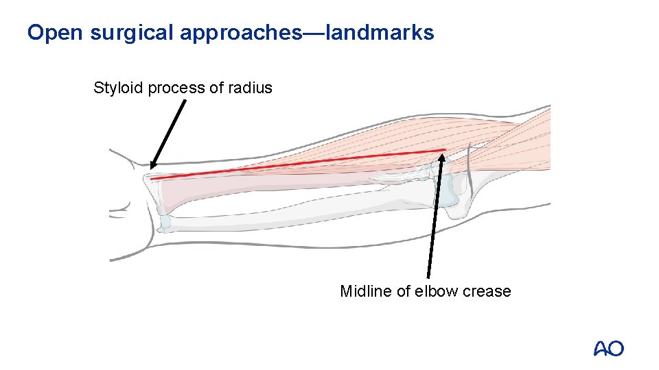 Open surgical approaches—landmarks Styloid process of radius Midline of elbow crease 
