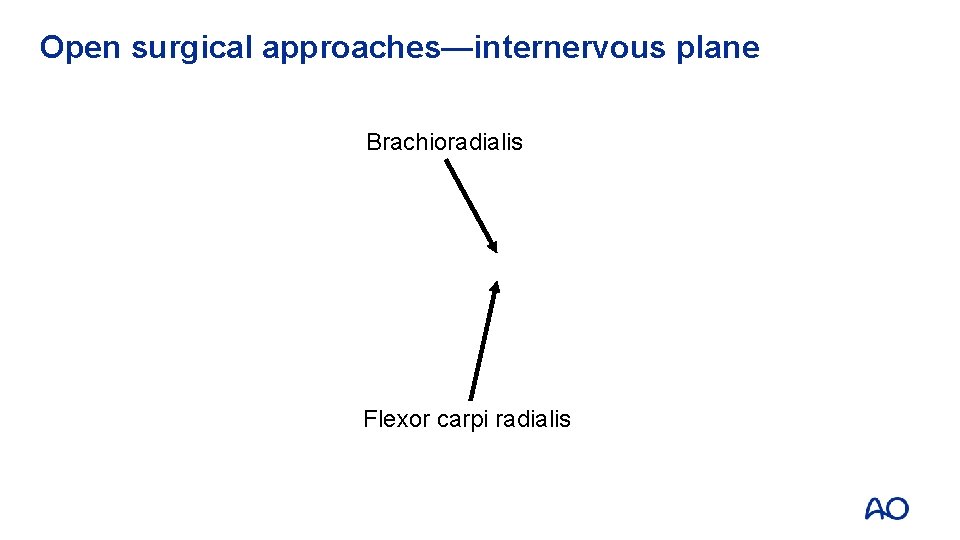 Open surgical approaches—internervous plane Brachioradialis Flexor carpi radialis 