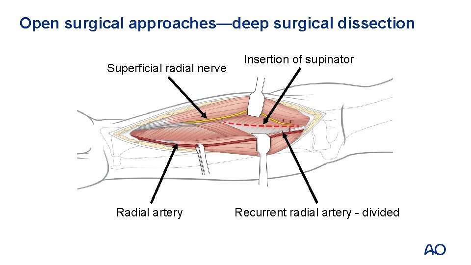 Open surgical approaches—deep surgical dissection Superficial radial nerve Radial artery Insertion of supinator Recurrent