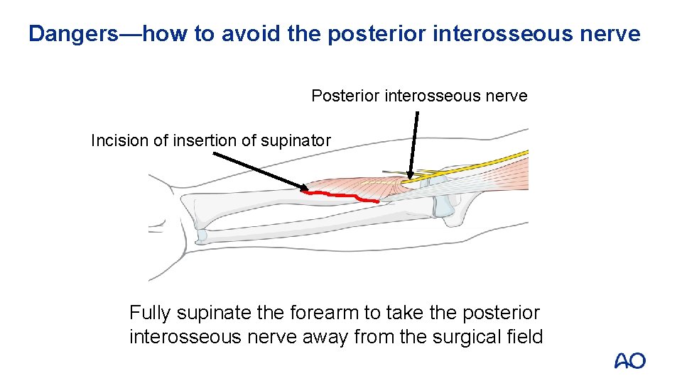 Dangers—how to avoid the posterior interosseous nerve Posterior interosseous nerve Incision of insertion of