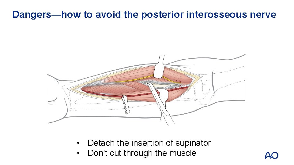 Dangers—how to avoid the posterior interosseous nerve • Detach the insertion of supinator •