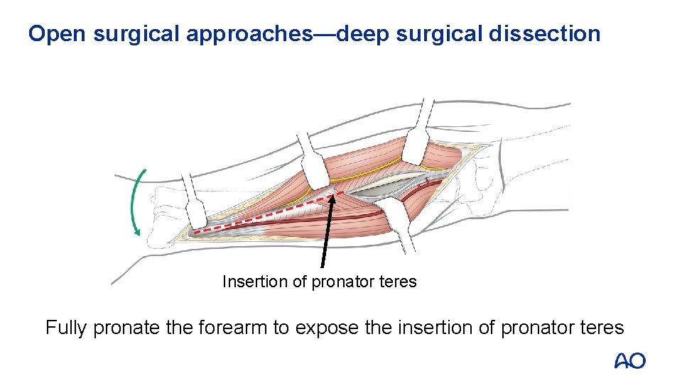 Open surgical approaches—deep surgical dissection Insertion of pronator teres Fully pronate the forearm to