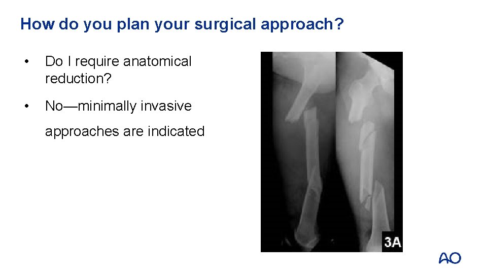 How do you plan your surgical approach? • Do I require anatomical reduction? •