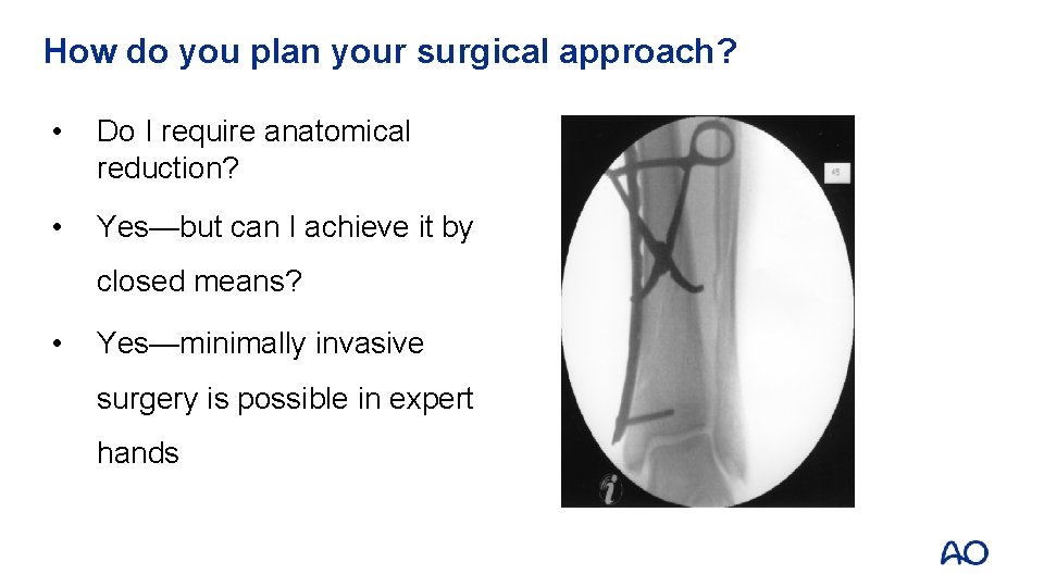 How do you plan your surgical approach? • Do I require anatomical reduction? •