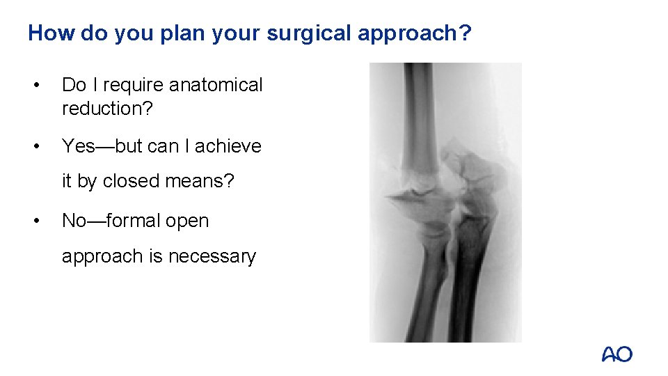 How do you plan your surgical approach? • Do I require anatomical reduction? •