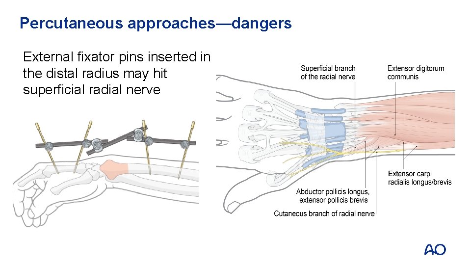 Percutaneous approaches—dangers External fixator pins inserted in the distal radius may hit superficial radial