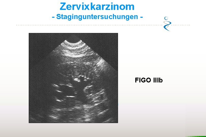 Zervixkarzinom - Staginguntersuchungen - FIGO IIIb 