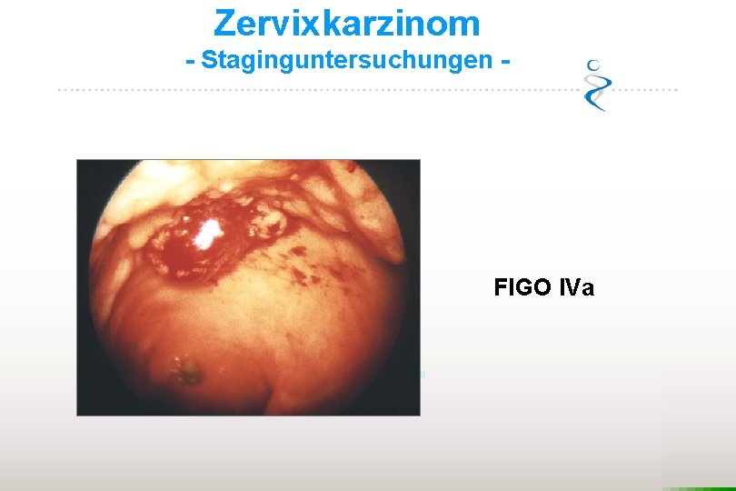 Zervixkarzinom - Staginguntersuchungen - FIGO IVa 