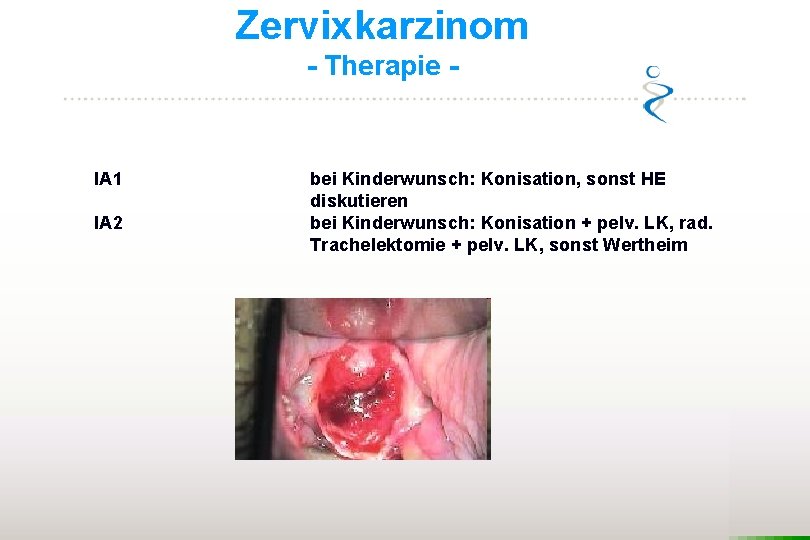 Zervixkarzinom - Therapie - IA 1 IA 2 bei Kinderwunsch: Konisation, sonst HE diskutieren