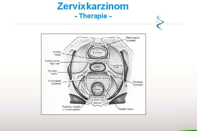 Zervixkarzinom - Therapie - 