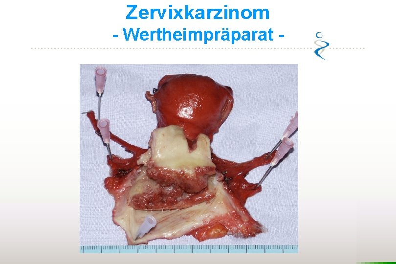 Zervixkarzinom - Wertheimpräparat - 
