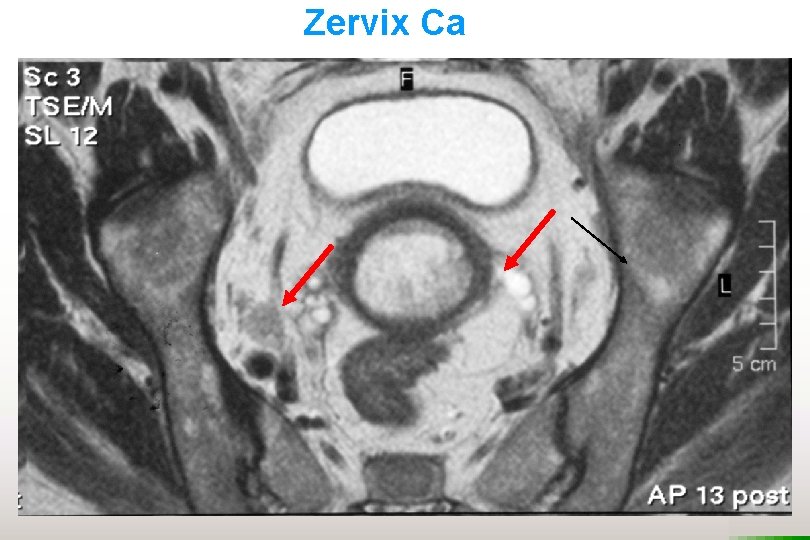 Zervix Ca 