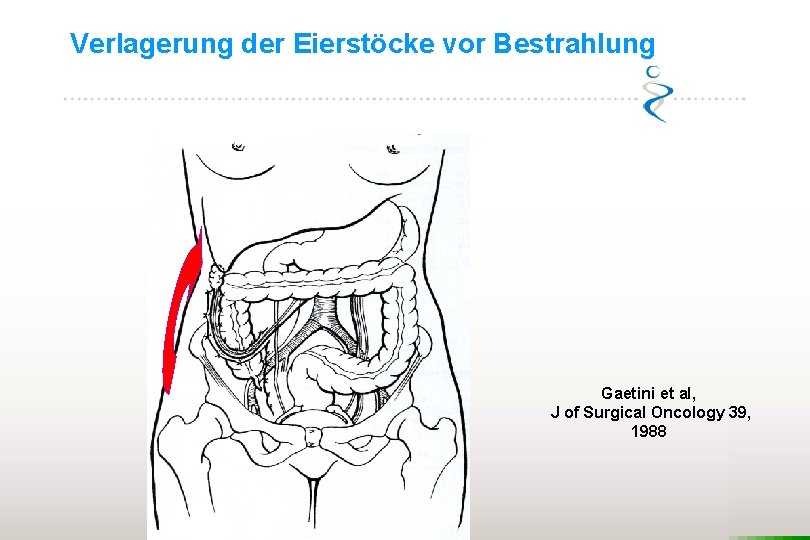 Verlagerung der Eierstöcke vor Bestrahlung Gaetini et al, J of Surgical Oncology 39, 1988