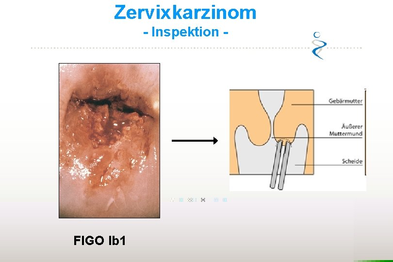 Zervixkarzinom - Inspektion - FIGO Ib 1 