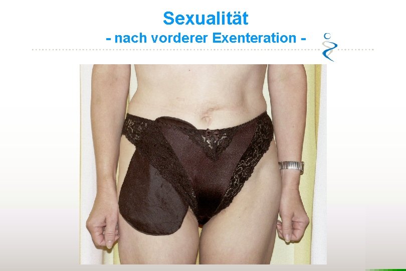 Sexualität - nach vorderer Exenteration - 