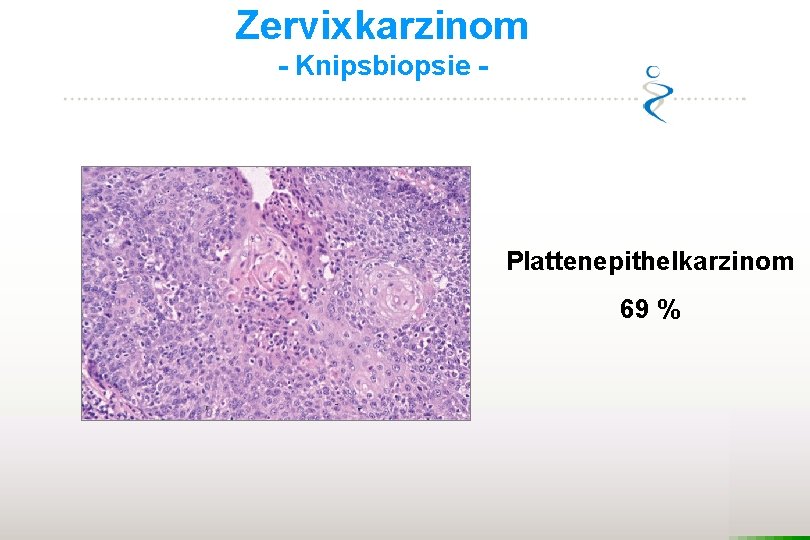 Zervixkarzinom - Knipsbiopsie - Plattenepithelkarzinom 69 % 