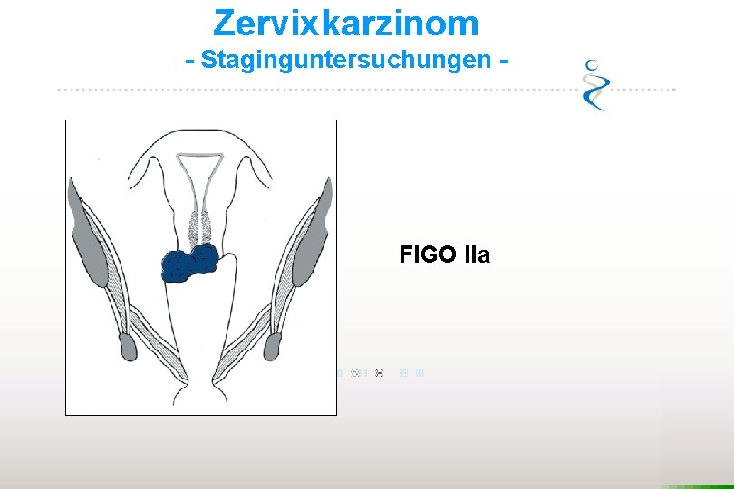 Zervixkarzinom - Staginguntersuchungen - FIGO IIa 