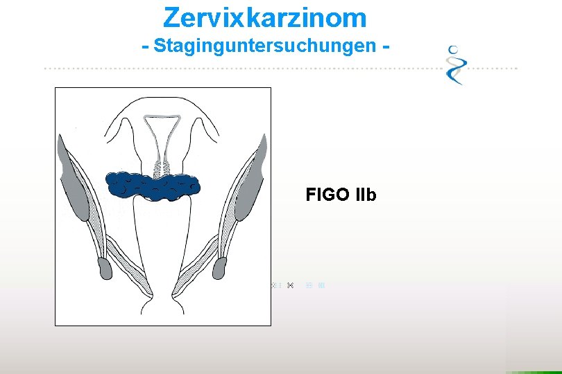 Zervixkarzinom - Staginguntersuchungen - FIGO IIb 