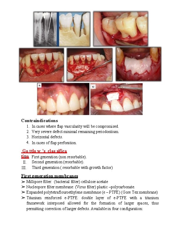 Contraindications 1. 2. 3. 4. In cases where flap vascularity will be compromised. Very