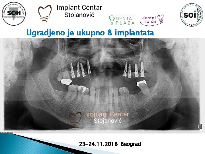 Ugradjeno je ukupno 8 implantata 23 -24. 11. 2018 Beograd 