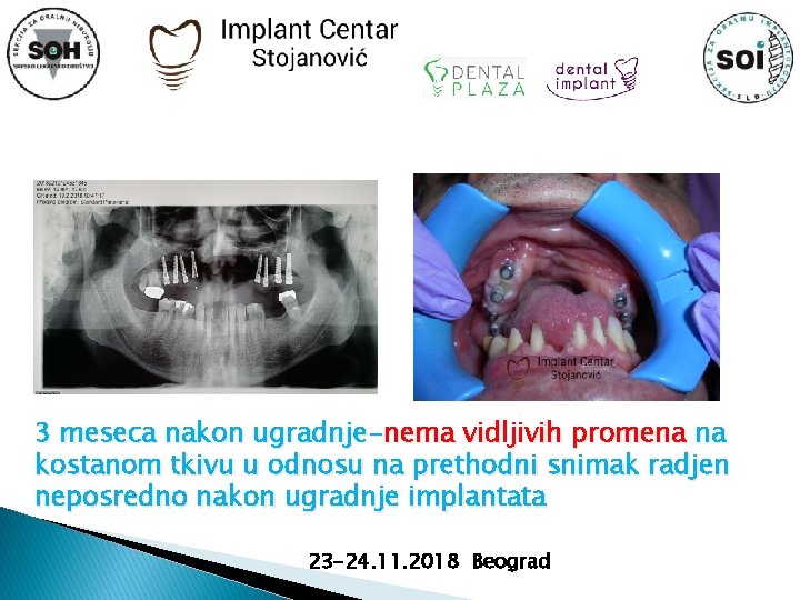 3 meseca nakon ugradnje-nema vidljivih promena na kostanom tkivu u odnosu na prethodni snimak