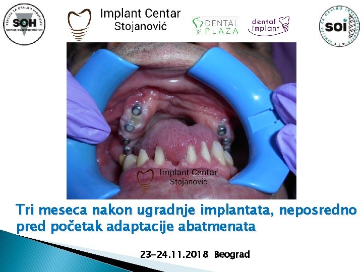 Tri meseca nakon ugradnje implantata, neposredno pred početak adaptacije abatmenata 23 -24. 11. 2018