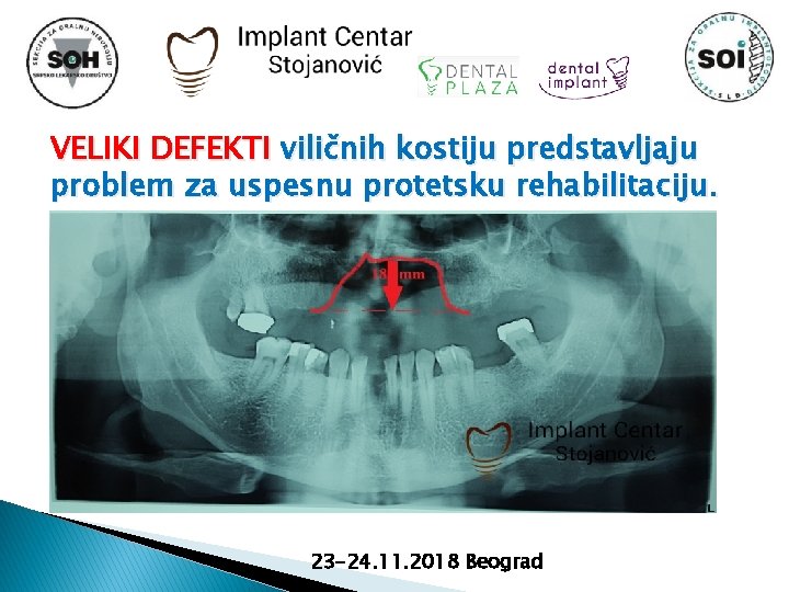 VELIKI DEFEKTI viličnih kostiju predstavljaju problem za uspesnu protetsku rehabilitaciju. 23 -24. 11. 2018