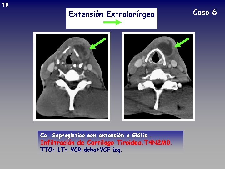 10 Caso 6 Extensión Extralaríngea Fig 24 Ca. Supraglotico con extensión a Glótis. Infiltración