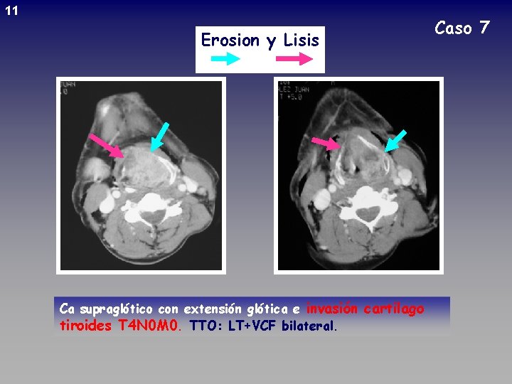 11 Erosion y Lisis Ca supraglótico con extensión glótica e invasión cartilago tiroides T