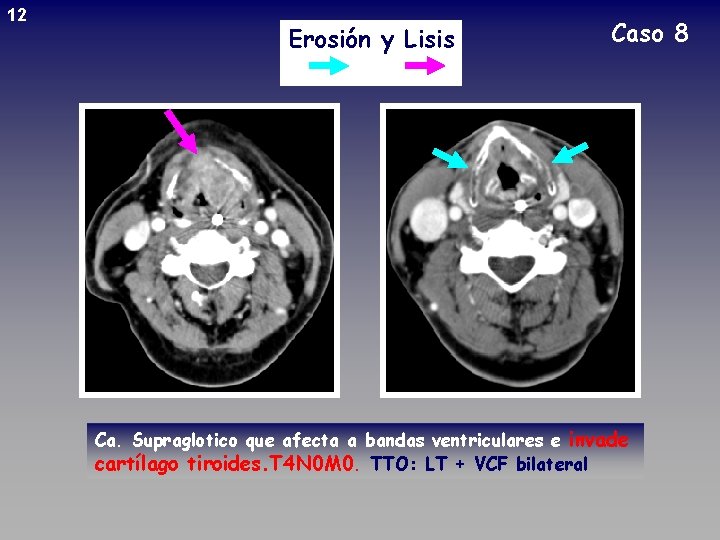 12 Erosión y Lisis Caso 8 Ca. Supraglotico que afecta a bandas ventriculares e