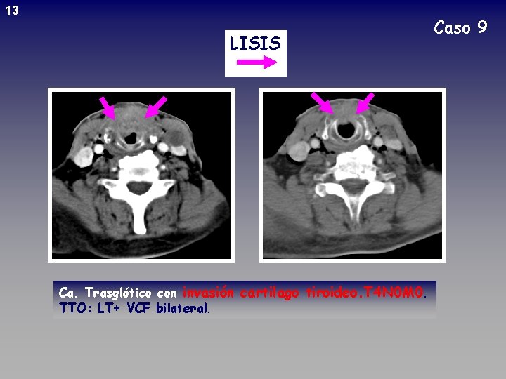13 LISIS Ca. Trasglótico con invasión cartilago tiroideo. T 4 N 0 M 0.