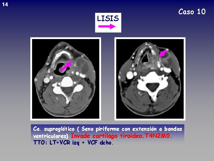 14 LISIS Caso 10 Ca. supraglótico ( Seno piriforme con extensión a bandas ventriculares)