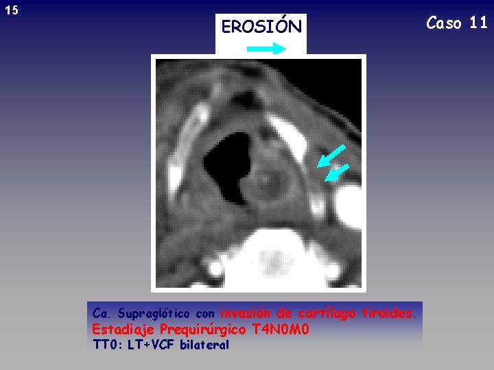 15 EROSIÓN Ca. Supraglótico con invasión de cartílago tiroides. Estadiaje Prequirúrgico T 4 N