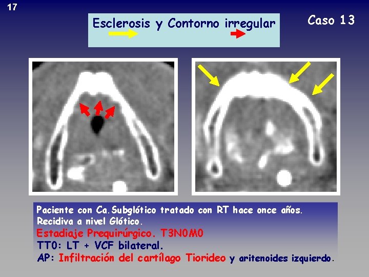 17 Esclerosis y Contorno irregular Paciente con Ca. Subglótico tratado con RT hace once