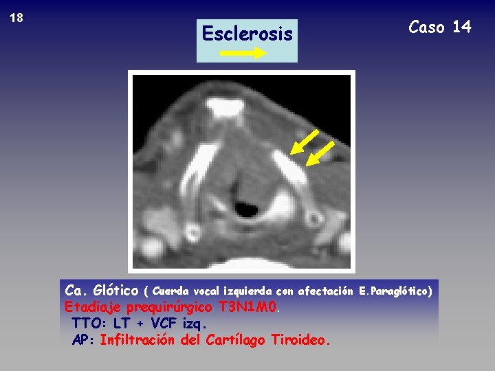 18 Esclerosis Ca. Glótico ( Cuerda vocal izquierda con afectación Etadiaje prequirúrgico T 3