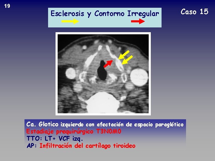 19 Esclerosis y Contorno Irregular Caso 15 Ca. Glotico izquierdo con afectación de espacio