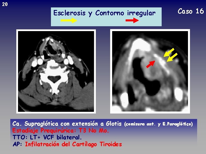 20 Esclerosis y Contorno irregular Ca. Supraglótica con extensión a Glotis Estadiaje Prequirúrica: T