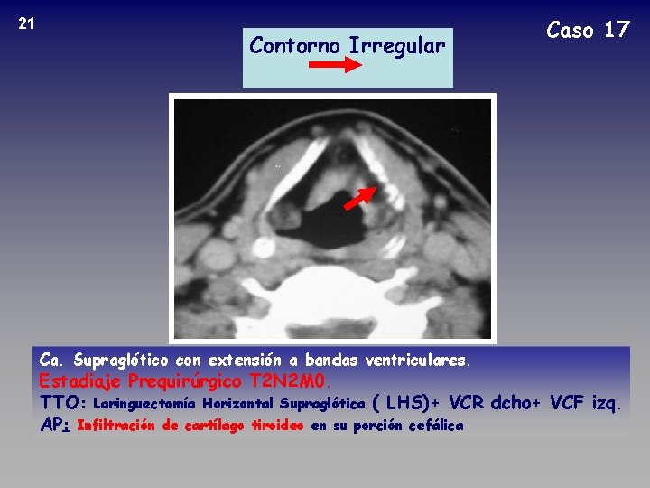 21 Contorno Irregular Caso 17 Ca. Supraglótico con extensión a bandas ventriculares. Estadiaje Prequirúrgico