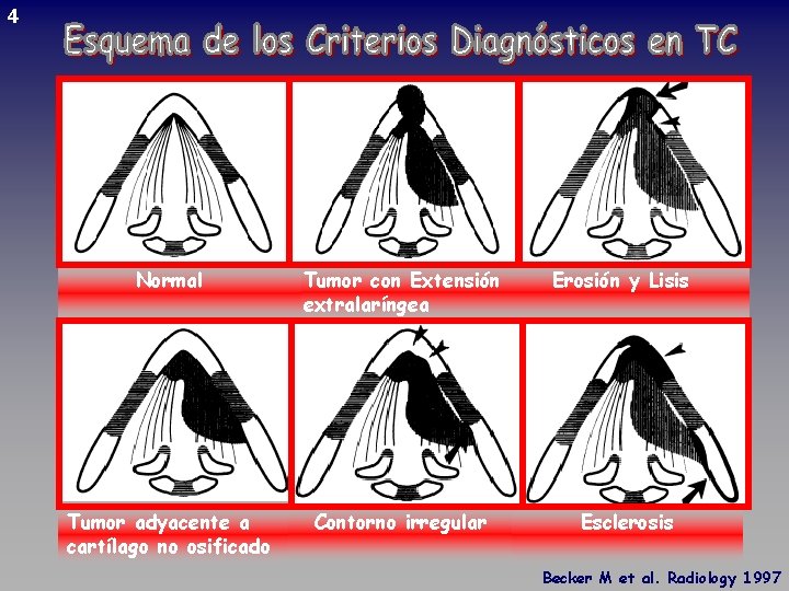 4 Normal Tumor con Extensión extralaríngea Erosión y Lisis Tumor adyacente a cartílago no