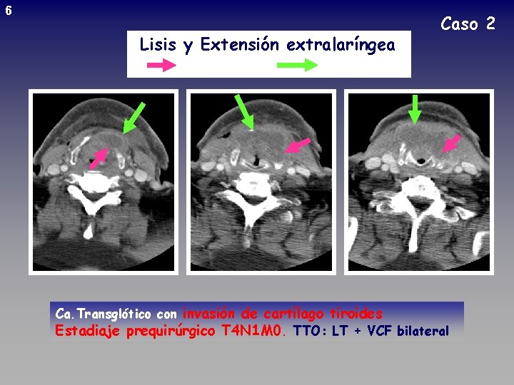 6 Lisis y Extensión extralaríngea Caso 2 Ca. Transglótico con invasión de cartílago tiroides