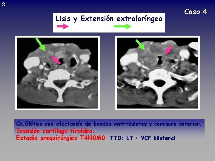 8 Lisis y Extensión extralaríngea Caso 4 Ca. Glótico con afectación de bandas ventriculares