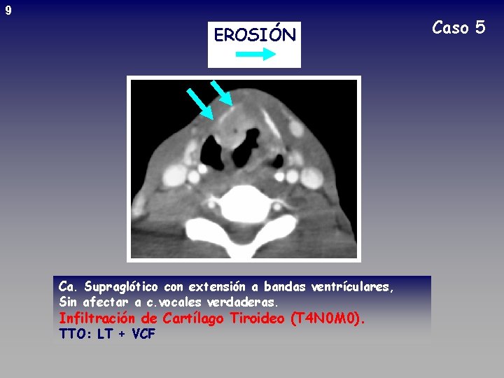 9 EROSIÓN Ca. Supraglótico con extensión a bandas ventrículares, Sin afectar a c. vocales