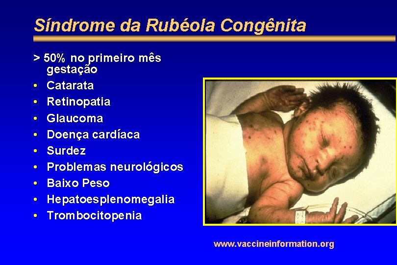 Síndrome da Rubéola Congênita > 50% no primeiro mês gestação • Catarata • Retinopatia