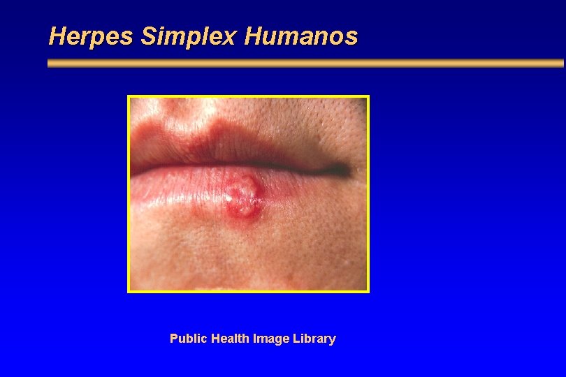 Herpes Simplex Humanos Public Health Image Library 
