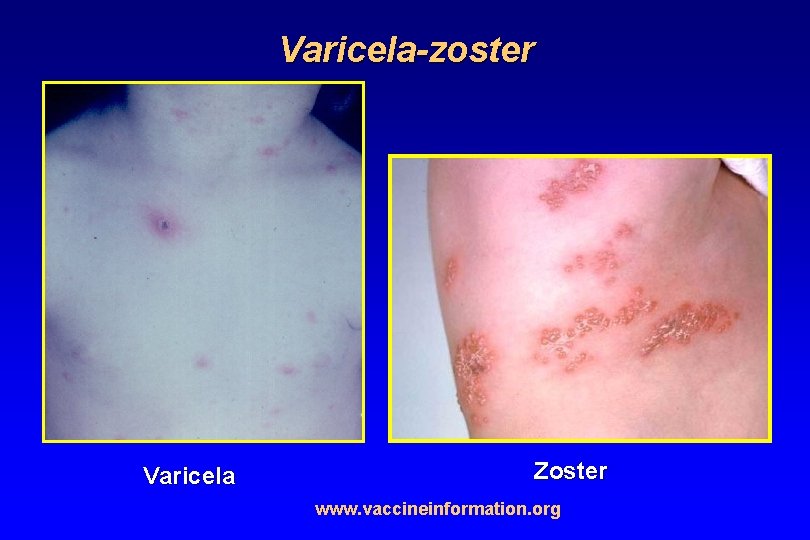 Varicela-zoster Varicela Zoster www. vaccineinformation. org 
