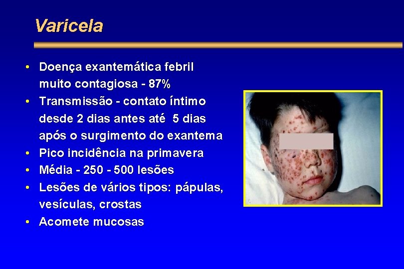 Varicela • Doença exantemática febril muito contagiosa - 87% • Transmissão - contato íntimo