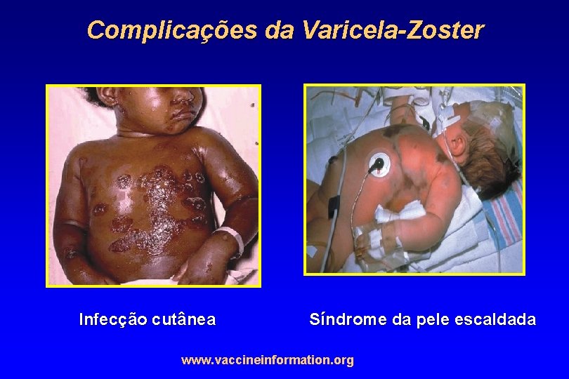 Complicações da Varicela-Zoster Infecção cutânea Síndrome da pele escaldada www. vaccineinformation. org 